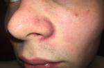 Покраснение вокруг носа и под нижней губой фото 2