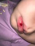 Ребёнок разбил губу образовалась гематома кровяная сверху фото 2