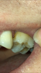 Почернела пломба и непонятое образование на зубе фото 2