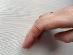 Трещины, зуд, шелушение кожи пальцев рук фото 3