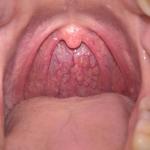 Болит горло, заложен нос, температура 37 два месяца фото 1