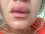 Опухают под утро губы, аллергию не показывает фото 2