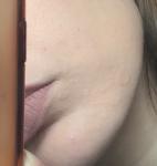 Покраснения шелушения на коже на лице и теле фото 2