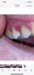 Десна около разрушенного зуба - боюсь что может быть рак фото 2