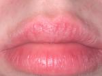 Красная кайма губ, сухость, жжение, мелкие пузыри фото 2