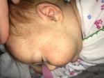 Аллергия и акне у месячного ребёнка фото 5