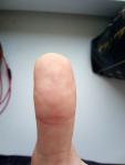 Сыпь под кожей на пальцах рук фото 1