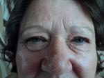 Зуд, отечность глаз после лечения стафилококка фото 2