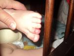 Водянистые пузыри на пальцах рук и ног фото 4
