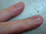 Мелкие водянистые пузырьки на пальцах рук фото 2