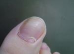 Нарост у основания ногтя большого пальца ноги фото 1