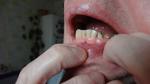 Коронка ПОД сточенный зуб с черным пятном у десны фото 1