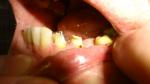 Коронка ПОД сточенный зуб с черным пятном у десны фото 2