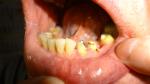 Коронка ПОД сточенный зуб с черным пятном у десны фото 3