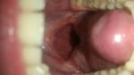 Желтые образования на стенке горла. Нездоровый вид горла после тонзиллэктомии фото 1