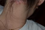 Шелушение и зуд волосистой части головы фото 1