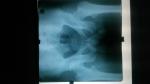 Расшифровка рентгена таза фото 1