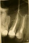 Болит зуб после лечения каналов фото 1