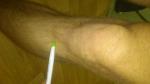 Гиперчуствительность сухожилия ниже колена снаружи фото 1