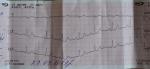 Расшифровка кардиограммы после лечения фото 1