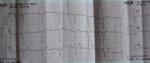 Расшифровка кардиограммы после лечения фото 3