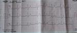 Расшифровка кардиограммы после лечения фото 4