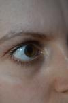 Узелки на белках глаз фото 2