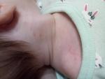 Сыпь на лице у новорожденного фото 1
