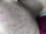 Сыпь дерматит аллергия фото 2
