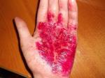 Вирусы провоцирующие острое течение кожных заболеваний фото 1