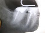 Боль в зубе с давно удалённым нервом фото 1