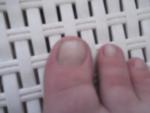 Грибок ногтя на ноге фото 4