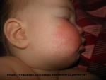 Красные щеки у ребенка 1г2м фото 3