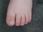 Ногти на ногах ребенка неправильной формы фото 1