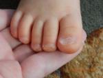 Ногти на ногах ребенка неправильной формы фото 5