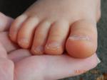 Ногти на ногах ребенка неправильной формы фото 2