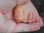 Ногти на ногах ребенка неправильной формы фото 4
