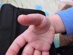 Шелушение пальчиков у ребенка фото 2