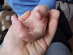 Шелушение пальчиков у ребенка фото 1