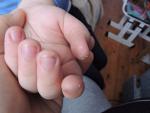 Шелушение пальчиков у ребенка фото 3