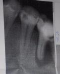 Не проходит опухоль на десне после удаления зуба фото 1