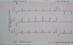 Интоксикация кардиограмма фото 2