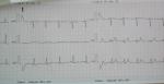 Интоксикация кардиограмма фото 3