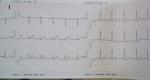 Интоксикация кардиограмма фото 4