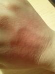 Шелушится кожа на руке, контактный аллергический дерматит фото 1