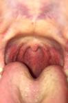 Воспалённое горло и хроническая мокрота фото 2