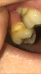 Почернела пломба и непонятое образование на зубе фото 1