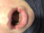 Может ли так начинаться рак губы? фото 4