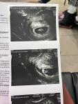 Расширение полости матки При беременности 7 недель и 3 дня фото 2