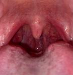 Сосуды в горле и миндалины фото 1